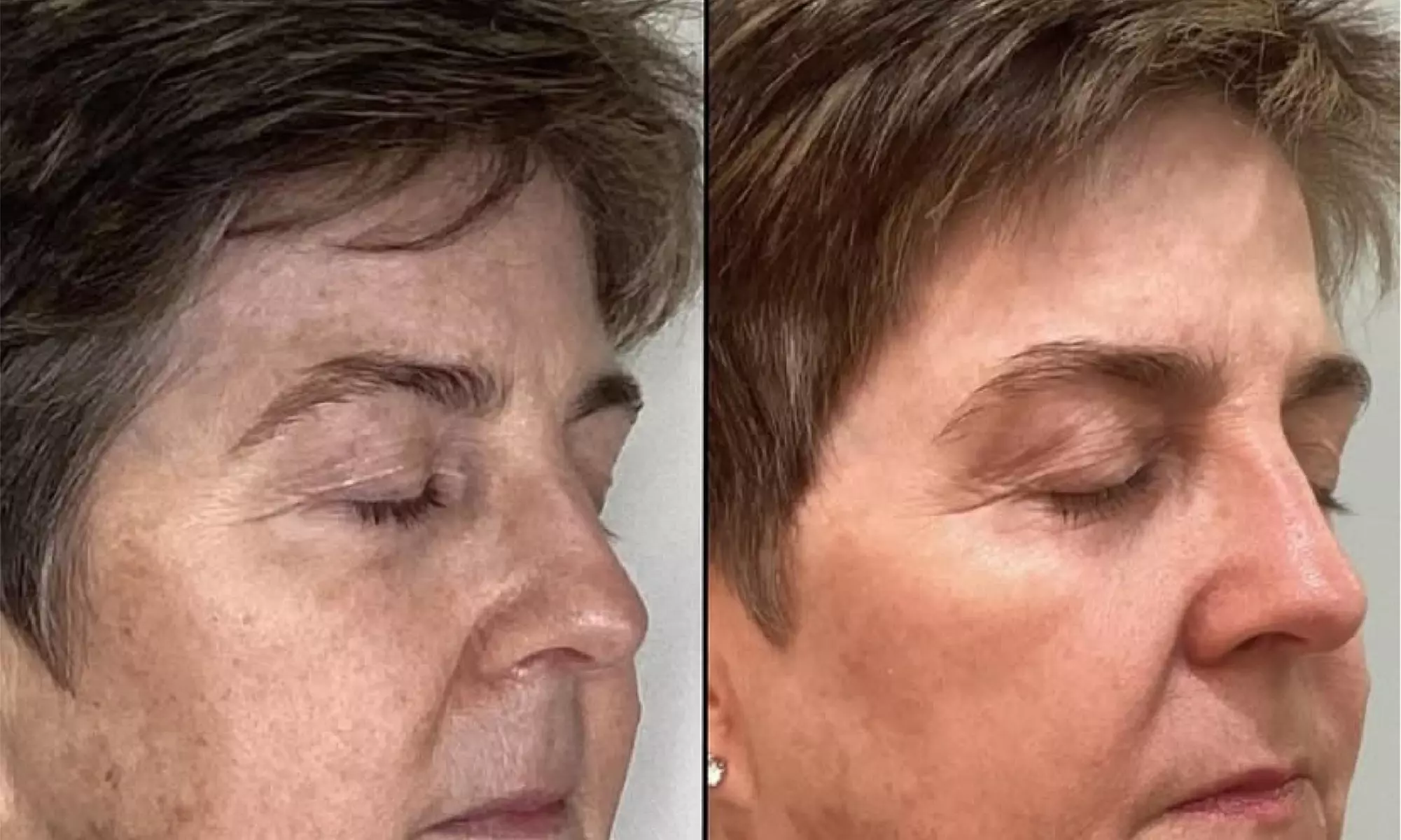 One/Three/Five TriLift w/ Deep Muscle Stimulation, RF & Microneedling