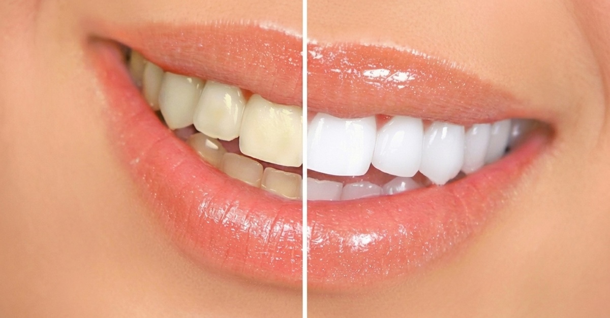 Blanqueamiento dental LED, limpieza bucal, pulido y fluoración en Alicante