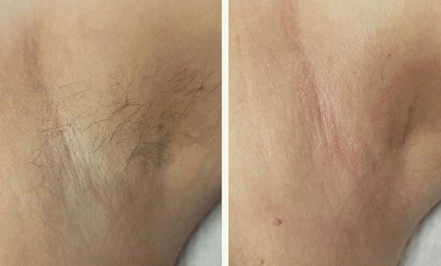 Image 3: Get 6 Laser Hair Removal Sessions on Any Area with Skinology Lab