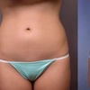 Image 4: Transform Your Body with One or Two CoolSculpting Treatments