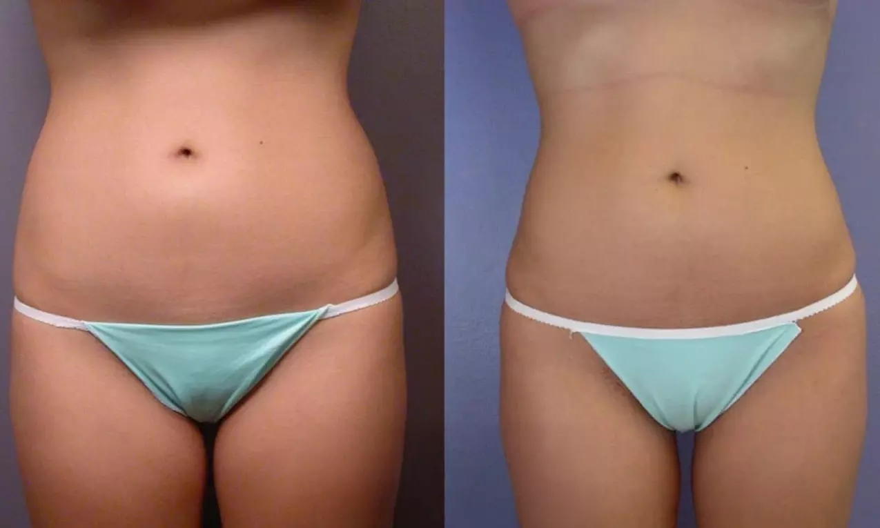 Transform Your Body with One or Two CoolSculpting Treatments