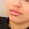 Image 1: Get Smooth Skin with 20 Units of Botox or Botox Lip Flip