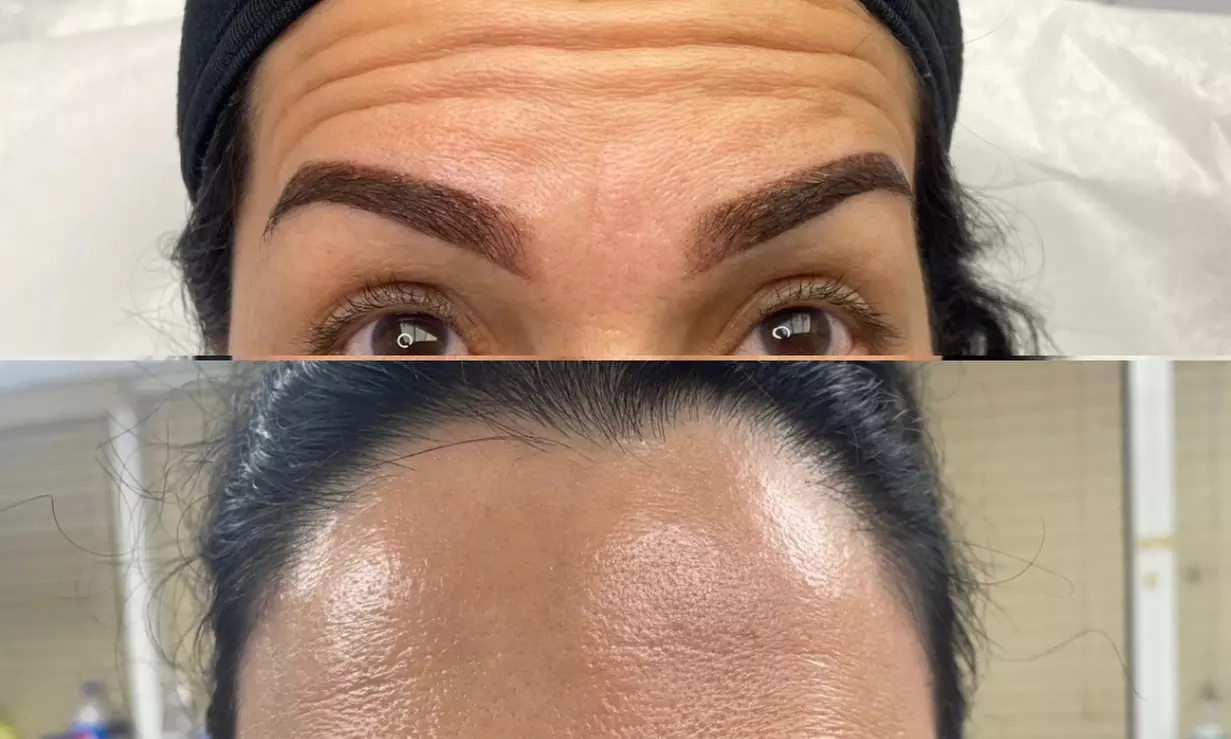 Revitalize with 20, 40, or 60 units Units of Jeuveau