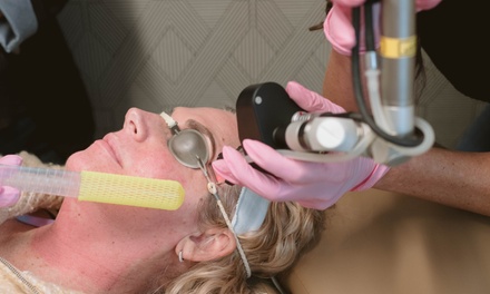 CO₂ Laser Resurfacing – Full Face - The Indy Med Spa