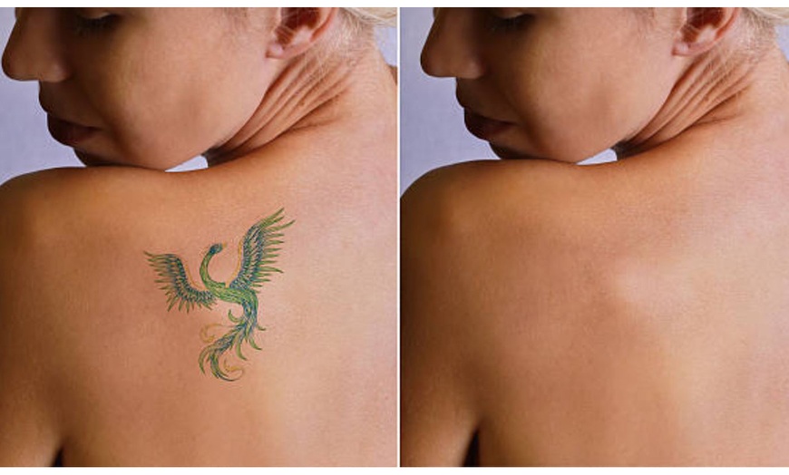 Image 8: Sesiones 3 o 6 para 5x5, 10x10 y 15x15 con láser q-switched Nd:YAG