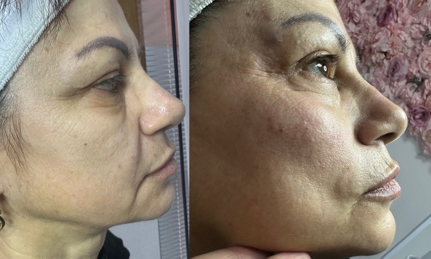 Image 8: Revitalize Your Look with Dermal Fillers
