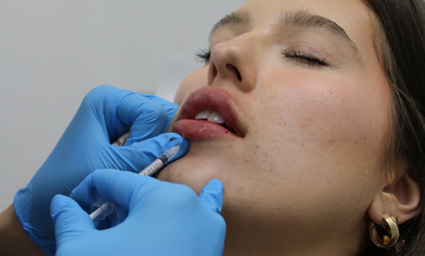 Image 3: 39% Off Smooth Lines with Juvederm Ultra XC