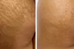 Get Inkless Stretch Mark & Scar Revision – Small/Medium/Large Area at Beauty by Nour - Up to 64% Off - Second Medium