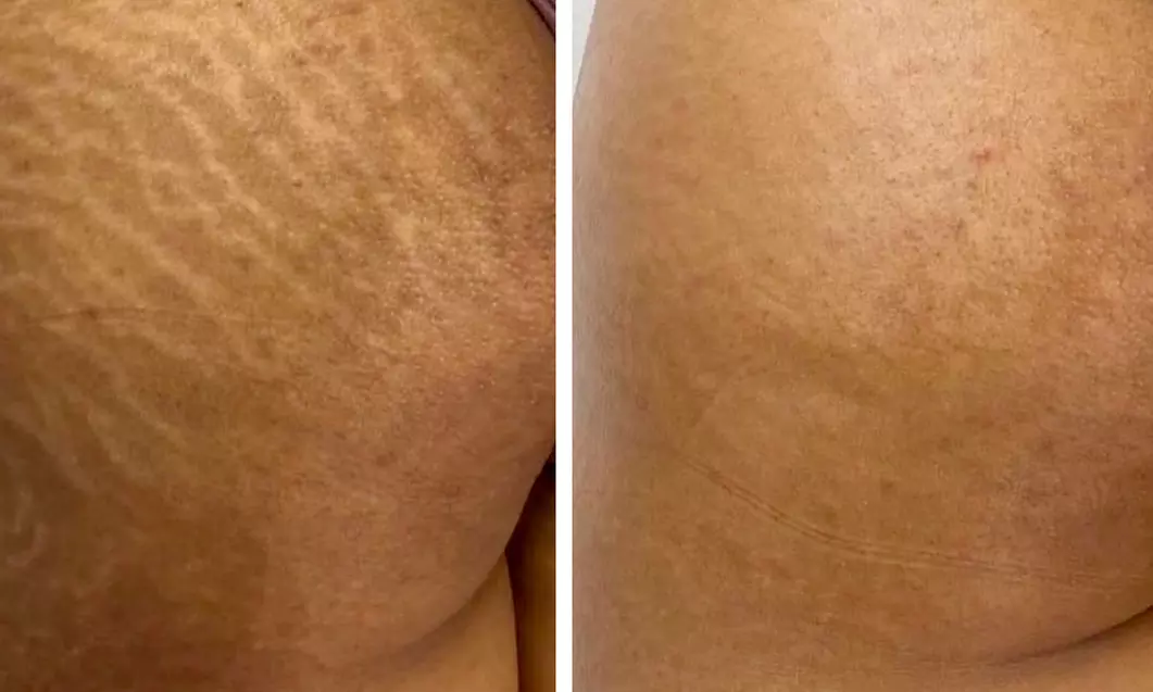 Get Inkless Stretch Mark & Scar Revision – Small/Medium/Large Area