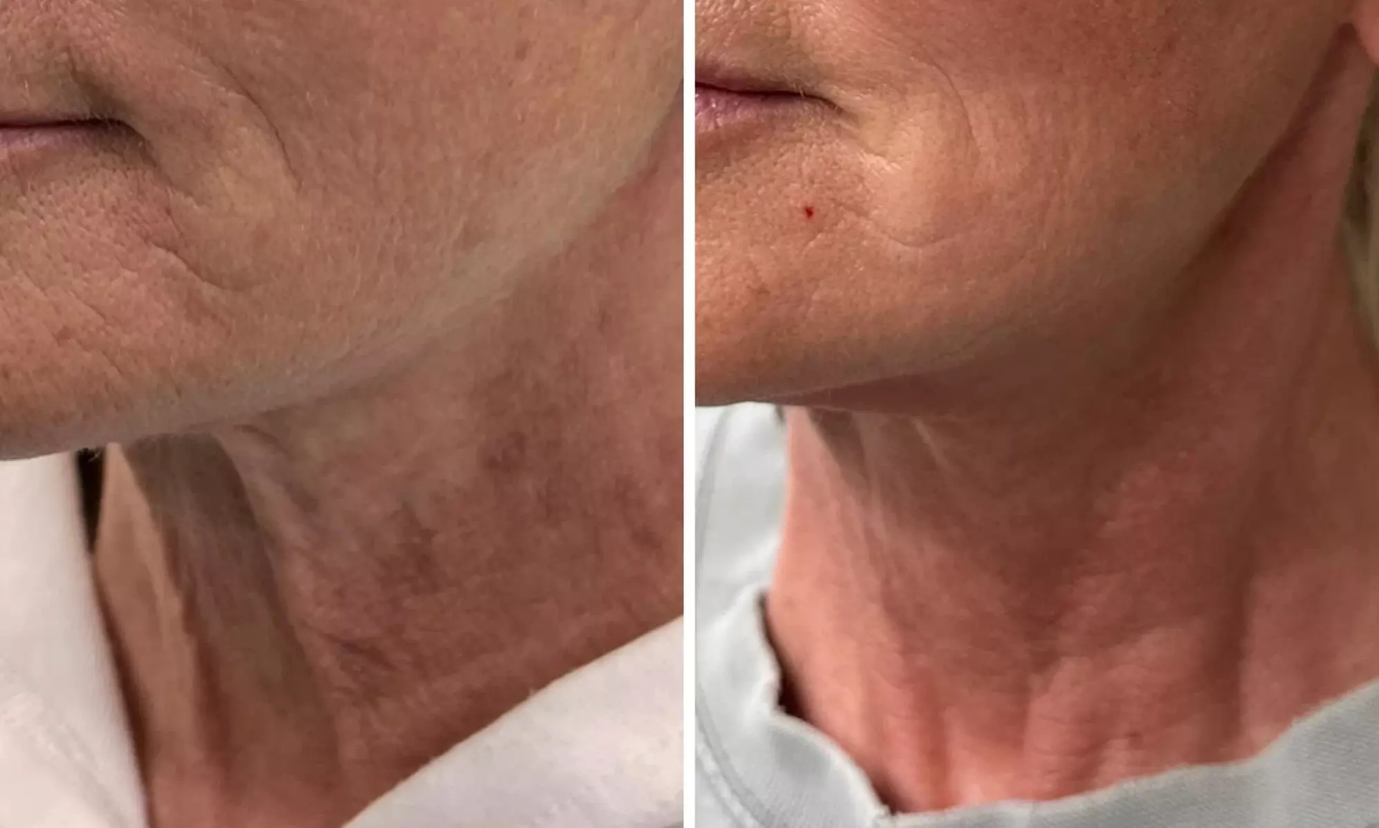 Permanent Makeup & Advanced Microchanneling