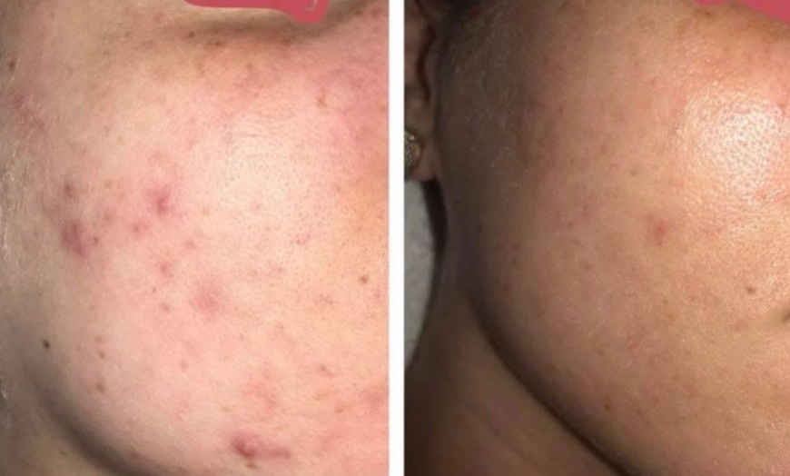 Image 1: Break Up With Breakouts: Pore-Cleansing Acne Facials & Treatments