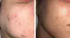 Break Up With Breakouts: Pore-Cleansing Acne Facials & Treatments at The Skin Sanctuary