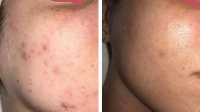 Break Up With Breakouts: Pore-Cleansing Acne Facials & Treatments at The Skin Sanctuary - Primary Image