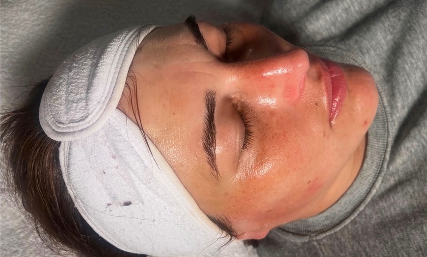 Image 1: One or Three Sessions of Microneedling with Skin Nourishing Serum