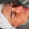 Image 1: One or Three Sessions of Microneedling with Skin Nourishing Serum