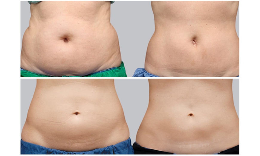 Image 2: Tone with EMS: 1, 2, 3, or 10 Sessions of Muscle Sculpting