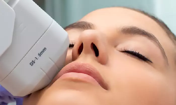 Radio Frequency Skin Tightening for the Face with PDT Light Treatments