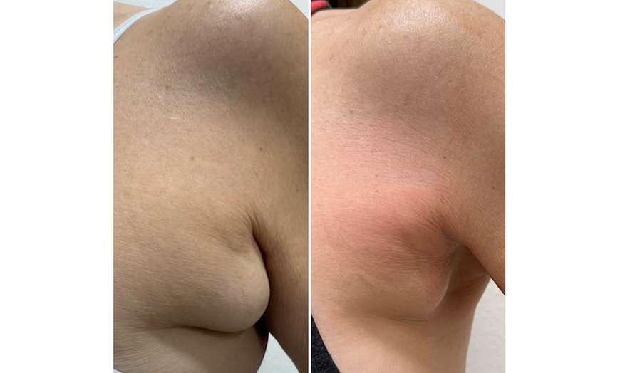 Image 8: Relax with Cryo & Thermal Body sculpting (2 or 3 sessions)