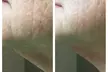 Revitalize with One or Three Teen/Adult Acne Laser Skin Resurfacing Sessions at D. R. Laser LLC (Up to 52%
Off) - Second Medium