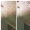 Image 4: Refresh Your Skin w/ 1 or 3 Teen Acne Laser Skin Resurfacing Sessions 