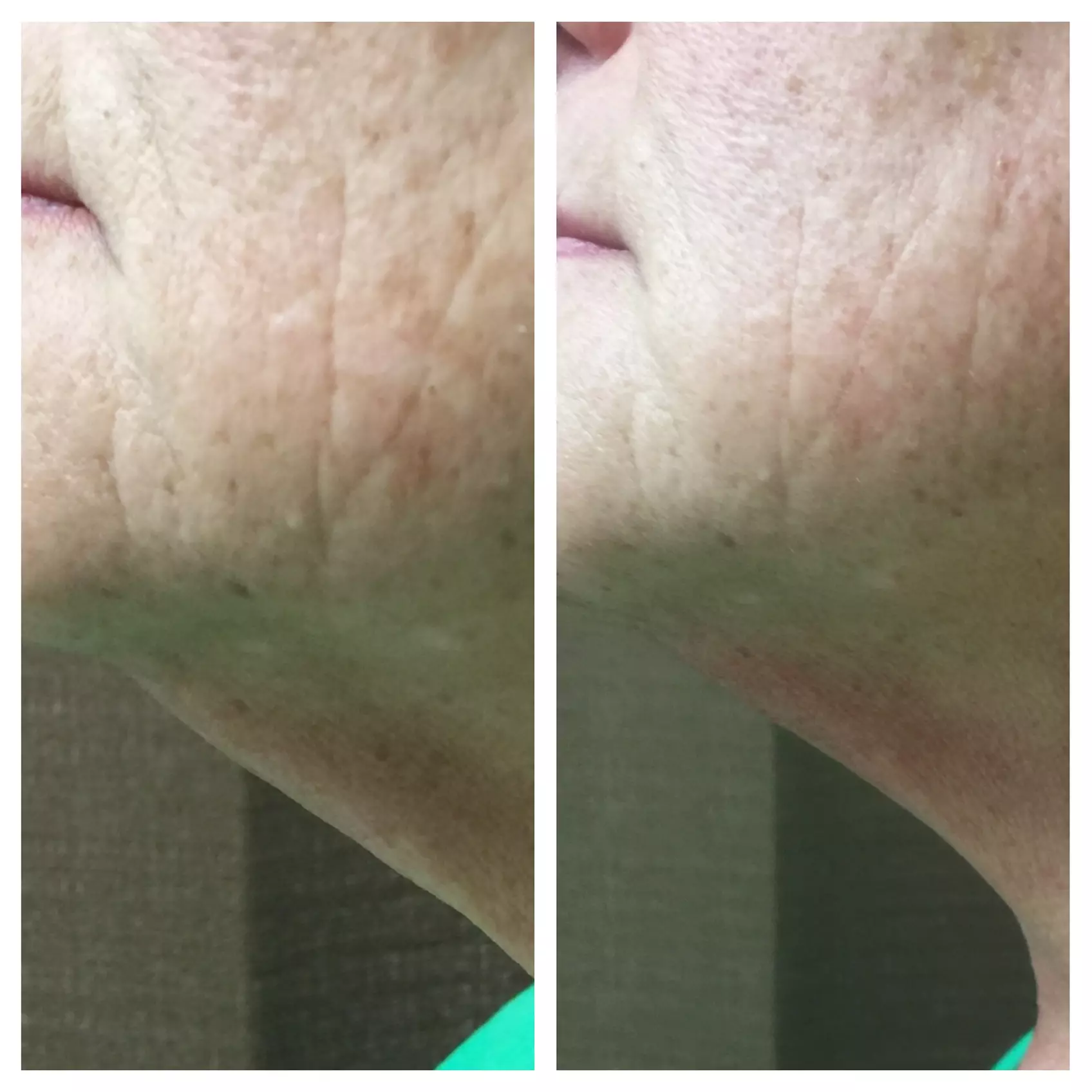 Refresh Your Skin w/ 1 or 3 Teen Acne Laser Skin Resurfacing Sessions