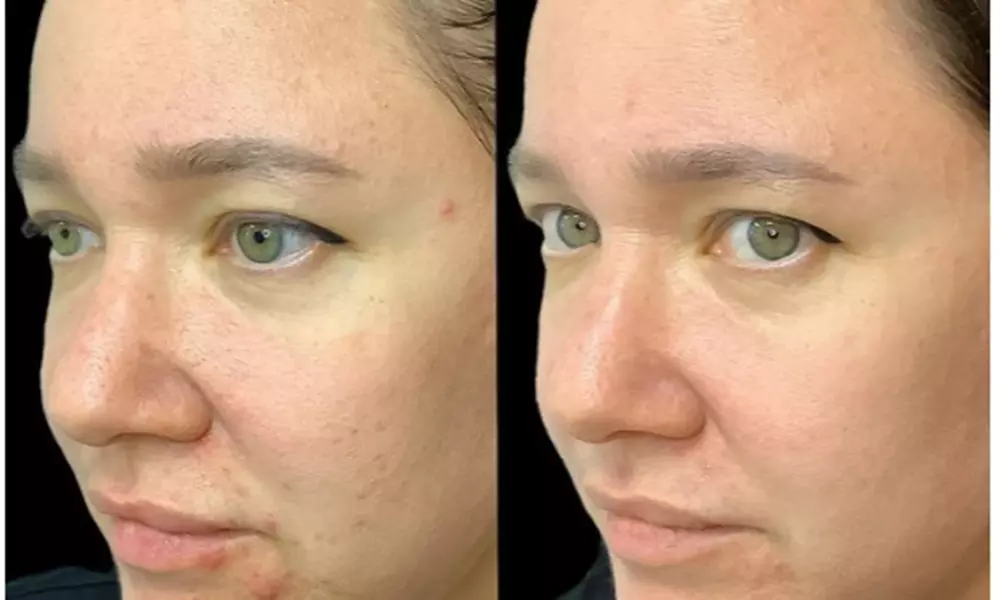 VI Peel Treatments for Aging, Acne, and Pigmentation Concerns