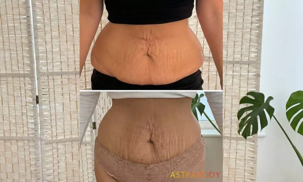 Sculpt Your Body with Two or Four Applicators: Cryolipolysis