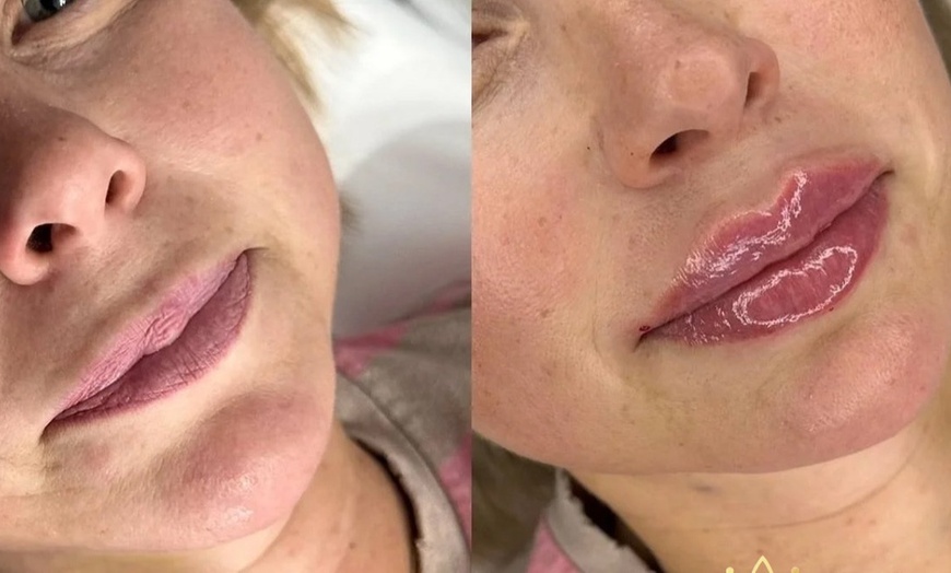 Image 1: Get a Dermal Filler Today: 1ml or 2ml Lips