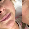 Image 1: Get a Dermal Filler Today: 1ml or 2ml Lips