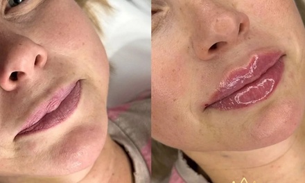 Dermal Filler: 1ml Lips - Benson Beauty Aesthetics