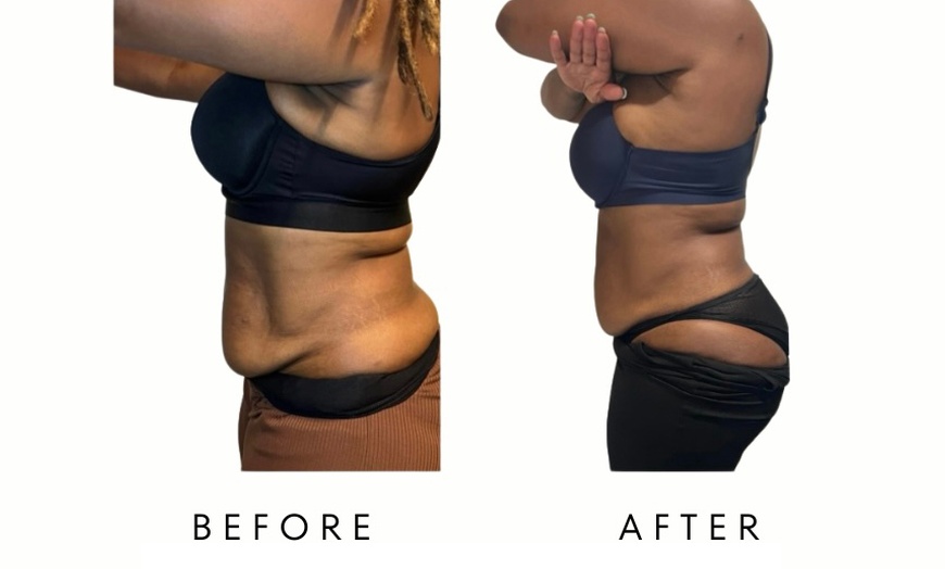 Image 3: PRECISION SLIM - Body Fat Loss & Skin Tightening at Your Sculpt Studio