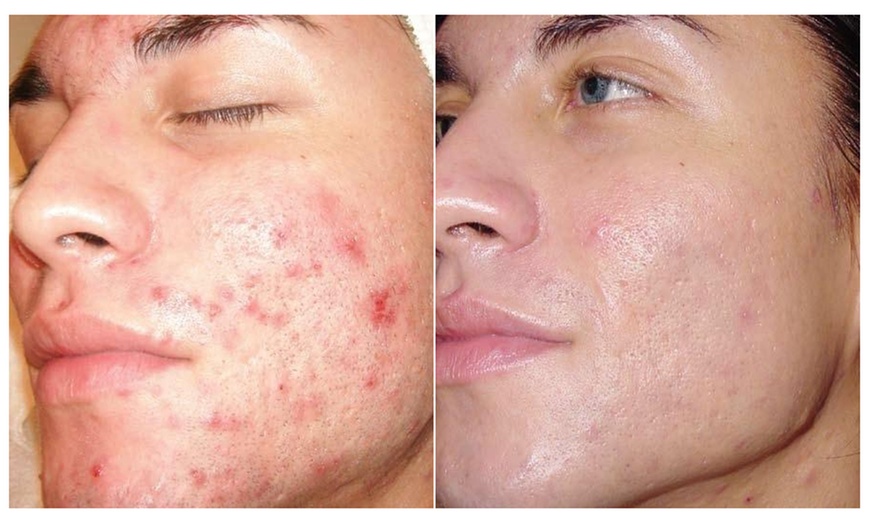 Image 2: Refresh with a Microdermabrasion Facial Session!