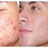 Image 2: Refresh with a Microdermabrasion Facial Session!