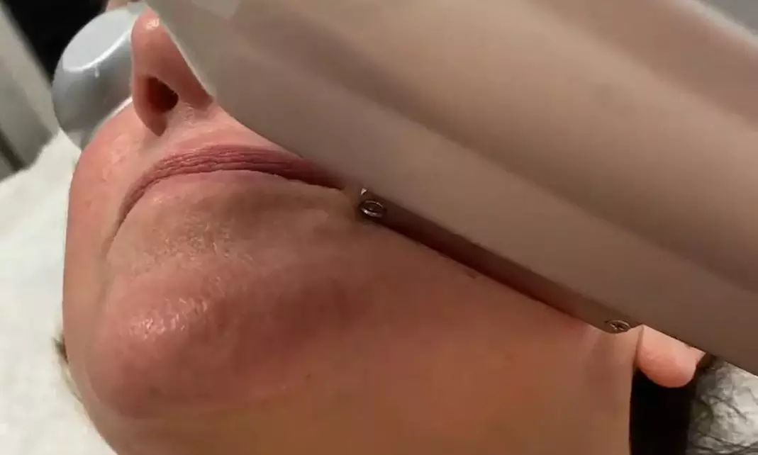 1 o 3 sesiones de tratamiento láser para manchas y acné