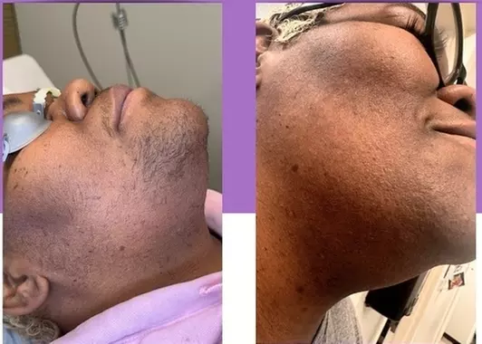 Muse Primary Care's laser hair removal treatments with up to 50% off, featuring single and multiple session options