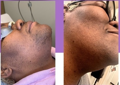 Seven Laser Hair Removal Sessions on a Small Area - Muse Primary Care & Obstetrics: Dr. Katosha Muse