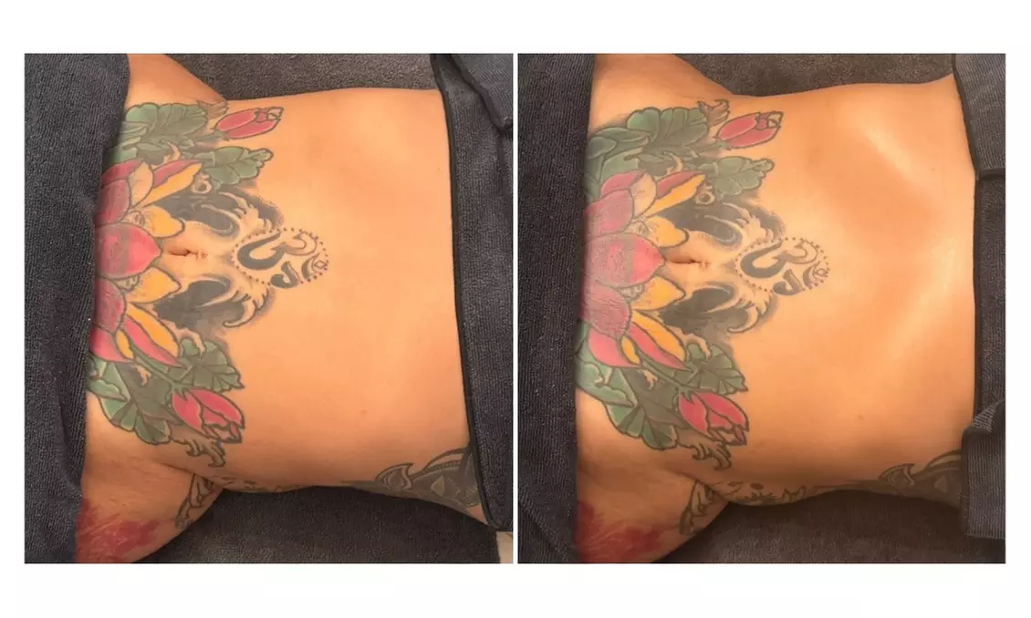Three, Six, Nine, or Twelve Snella Non-Invasive Laser Lipo Sessions
