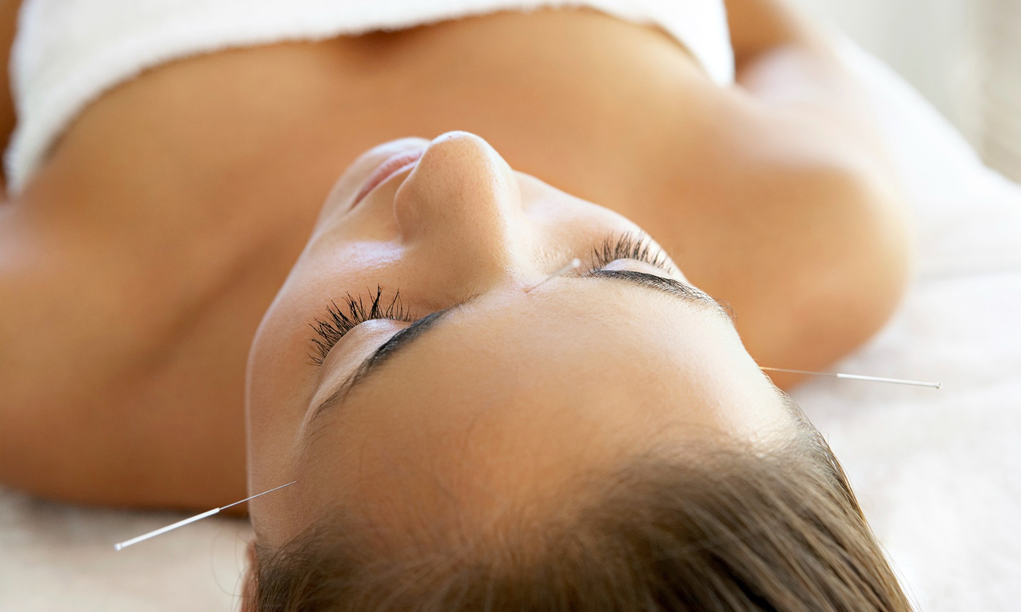 Acupuncture & Cupping Sessions for Relaxation and Healing