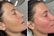CO2 Laser Skin Resurfacing – Smooth, Tighten & Renew with Up to 50% Off  at Healing Rivers Aesthetics - Second Medium