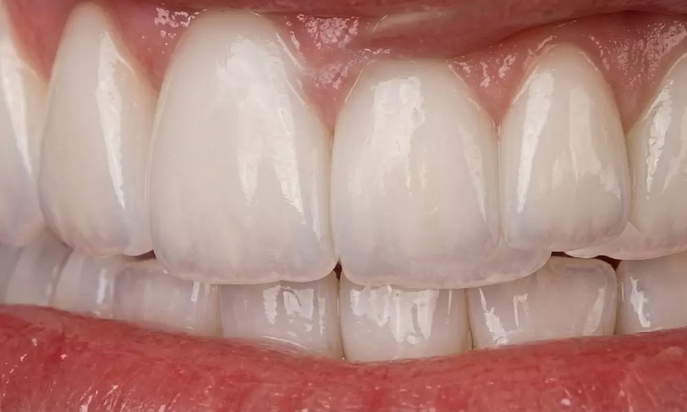 Comprehensive Exam, Veneers & Dental Implant Placement