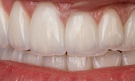 Veneer - Lumina Dental studio