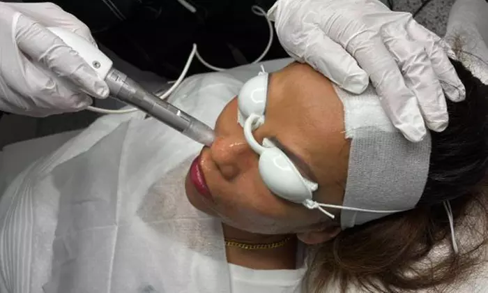 1 or 3 Sessions of RF Skin Tightening on Abdomen, Hips, Face & More