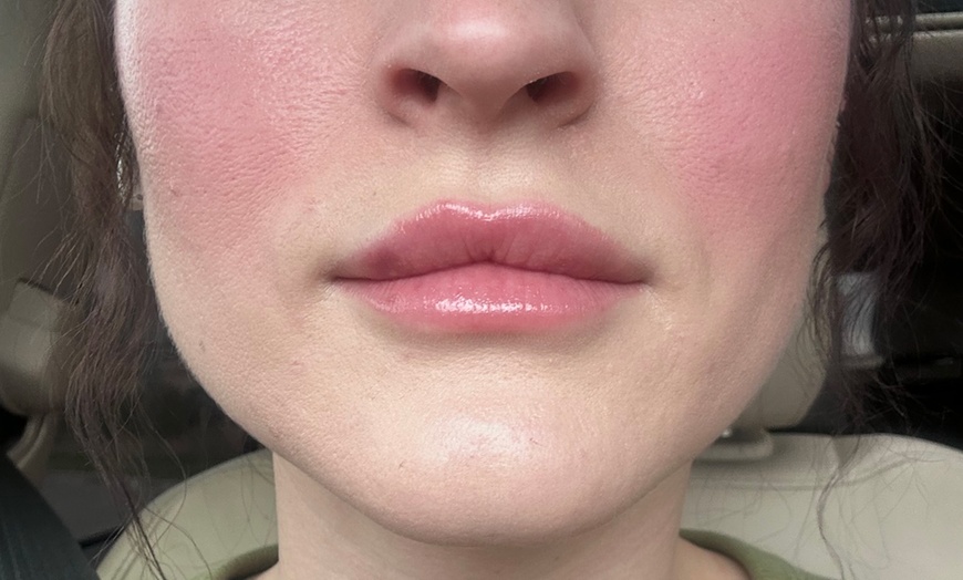 Image 2: 1 Syringe of Versa with Lip Flip or 1.2 ml Revanesse Versa