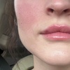 Image 2: 1 Syringe of Versa with Lip Flip or 1.2 ml Revanesse Versa