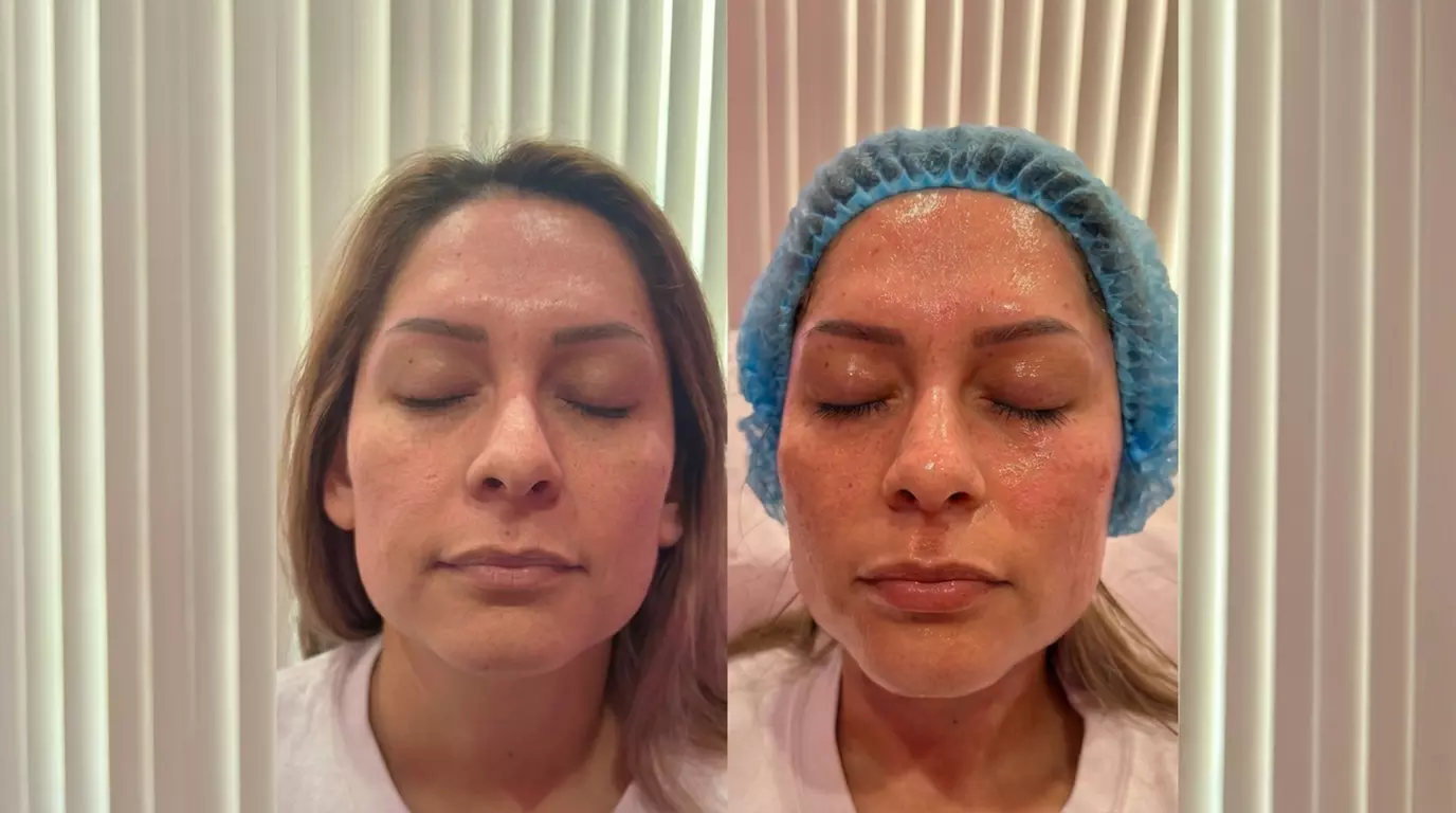 Natural Skin Rejuvenation with PRP Microneedling