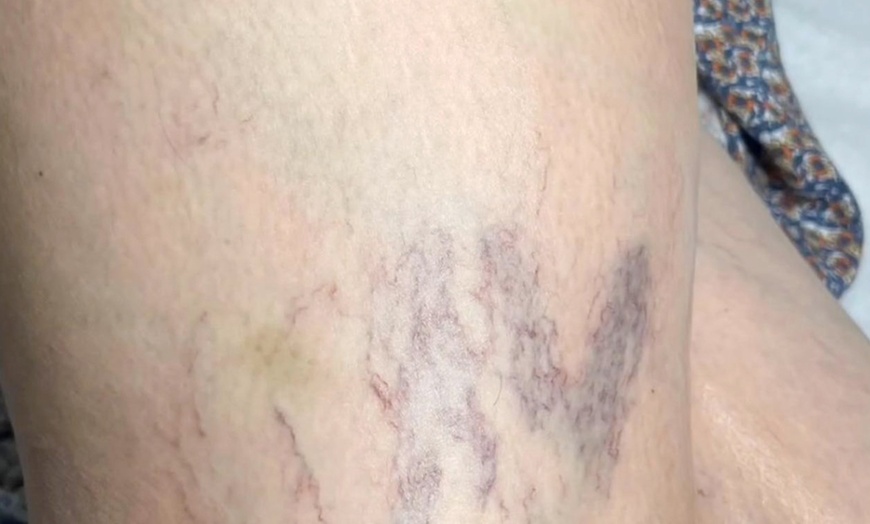 Image 1: Get Spider Vein Treatment for a 2x2 or 4x4 Area