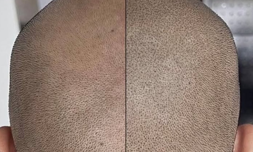 Image 4: Restore Confidence with Scalp Micropigmentation at Rose Beauty Bar
