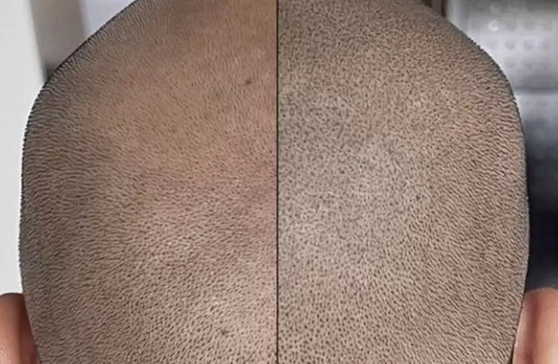 Restore Confidence with Up to 48% Off Scalp Micropigmentation at Rose Beauty Bar