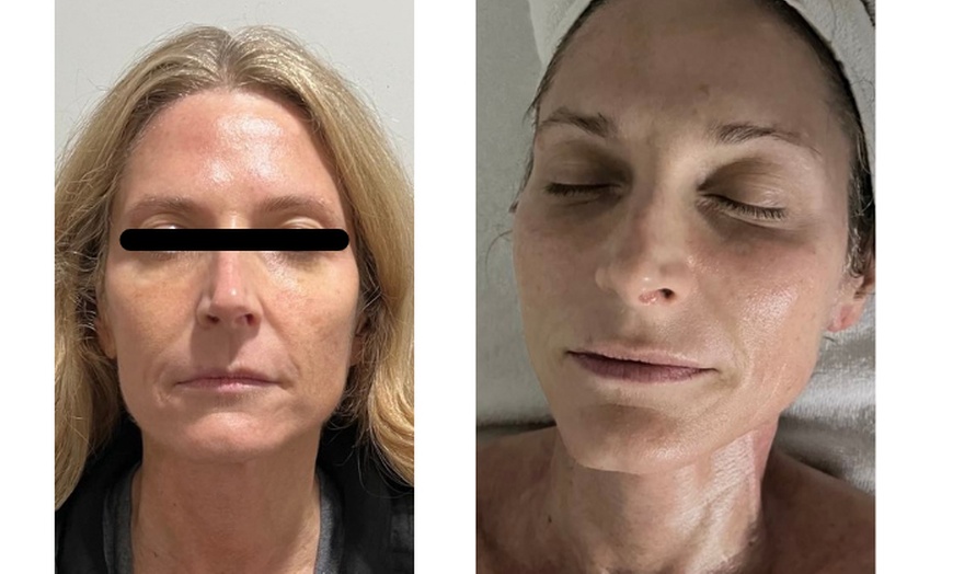 Image 4: Lift and Rejuvenate with HIFU Face, Neck, Chin Lift and More!