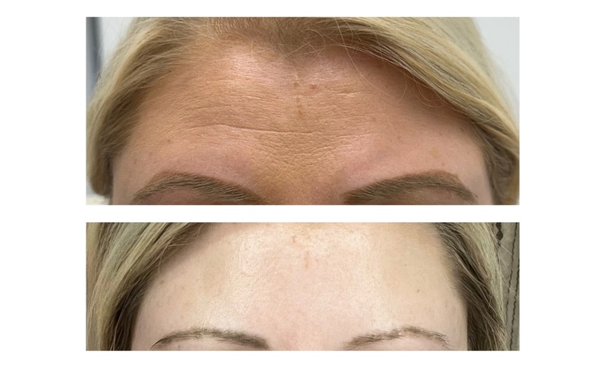 Image 6: Up to 31% Off on Injection - Xeomin at Get Tox'd Botox Medspa